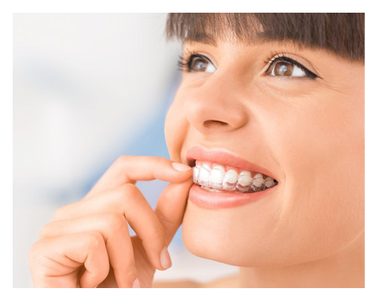 Invisalign Santa Clarita CA