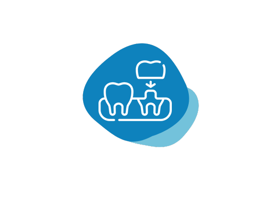 Metal free Crowns & Bridges | Crown Santa Clarita CA