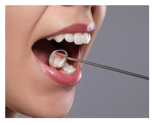 Tooth Colored Fillings | Dentist in Santa Clarita CA