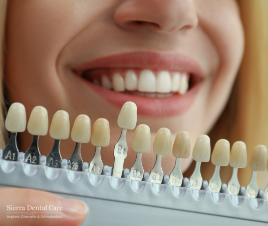Porcelain Veneers Santa Clarita CA