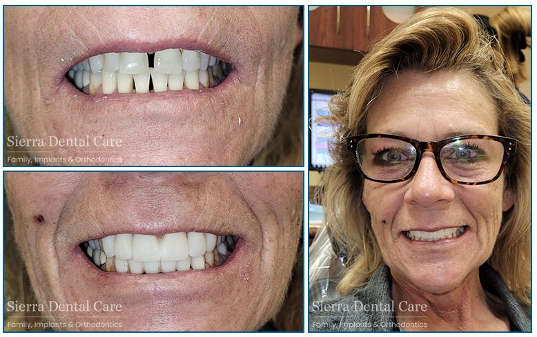 Invisalign Santa Clarita CA | Sierra Dental