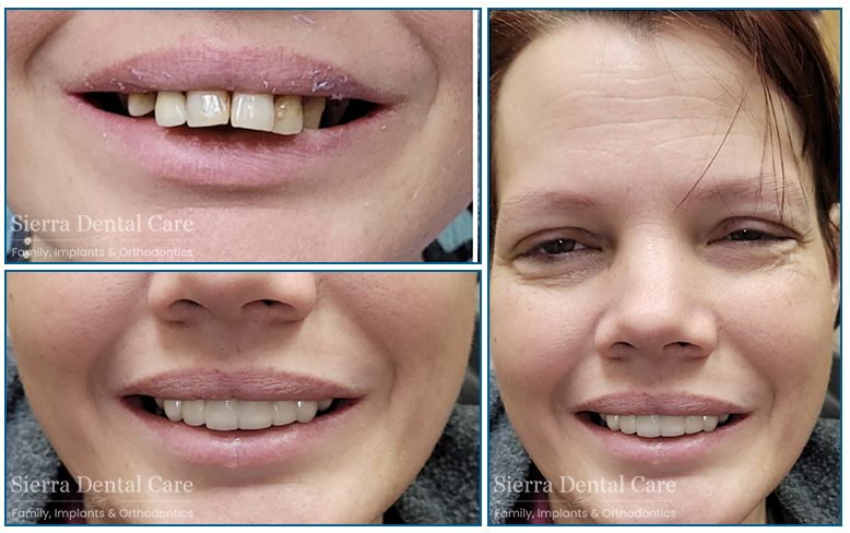 Sedation Dentistry Santa Clarita CA | Cosmetic Dentistry | Sierra Dental