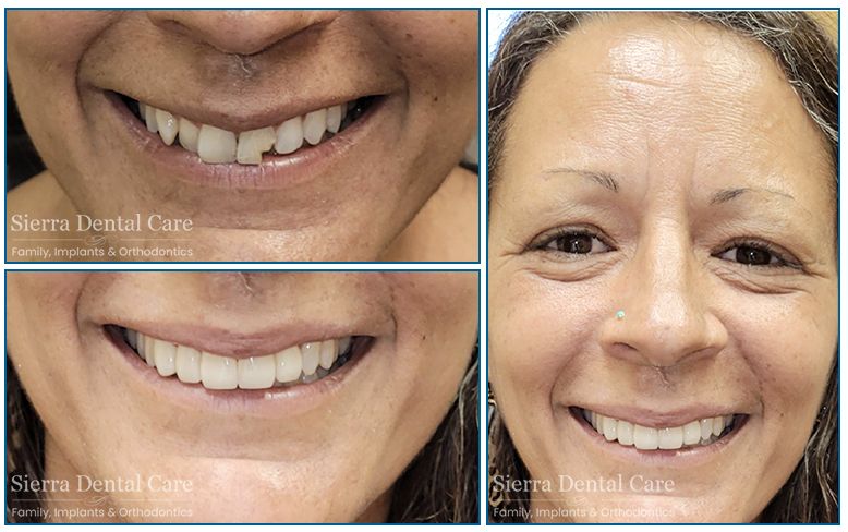 Crown Santa Clarita CA | Sierra Dental