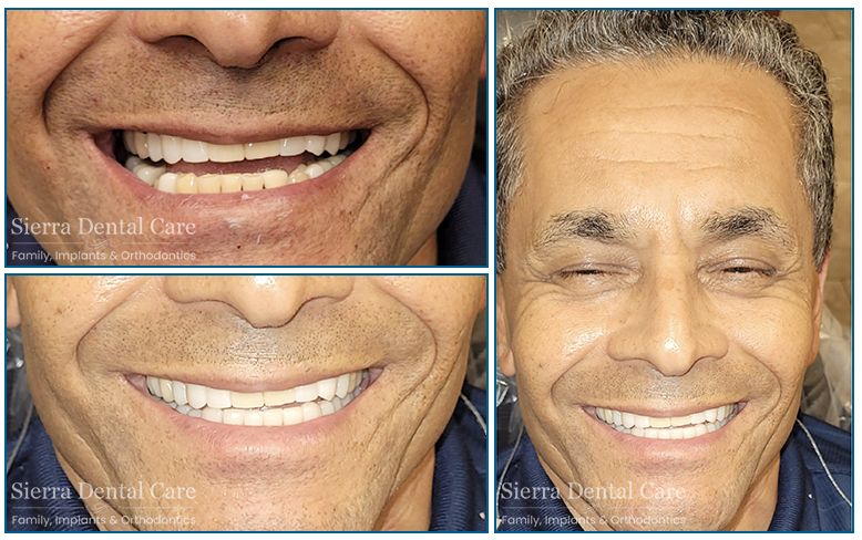 Dental Implants Santa Clarita CA | Sierra Dental
