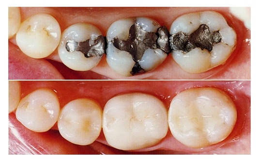 Tooth Colored Fillings Santa Clarita CA