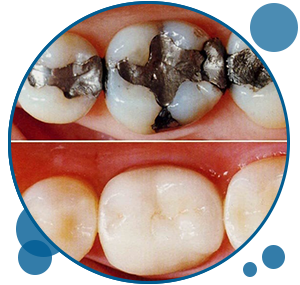 Tooth Colored Fillings | Dentist in Santa Clarita CA