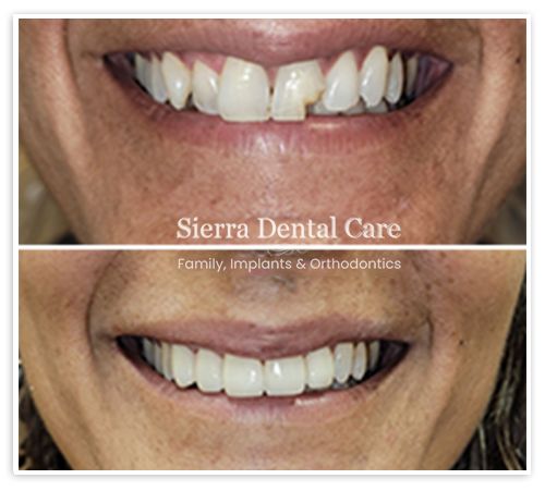 Invisalign Santa Clarita CA