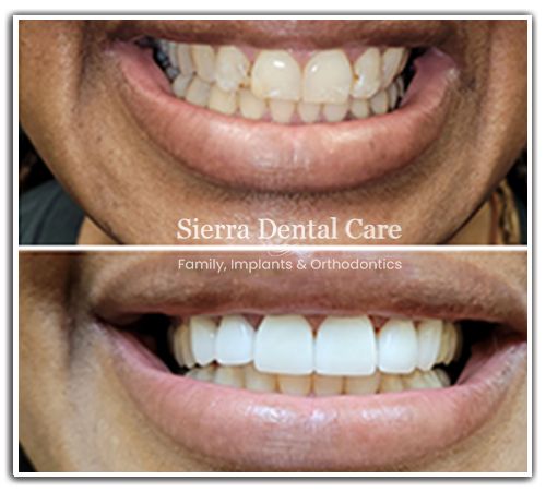 Cosmetic Dentistry Santa Clarita CA | invisalign