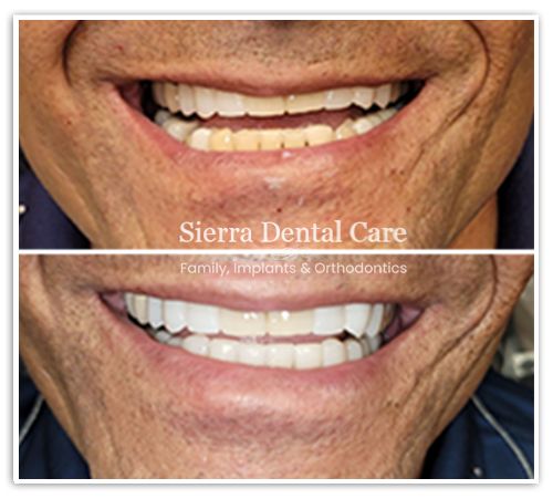 Wisdom Tooth Extraction Santa Clarita CA