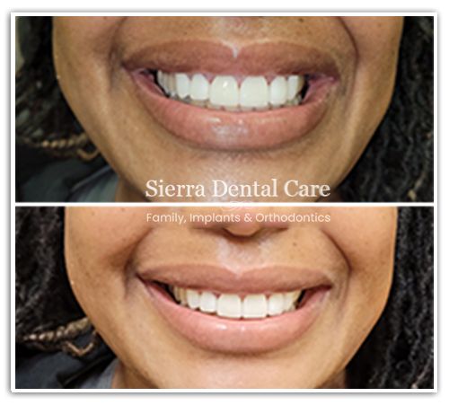 Invisalign Santa Clarita CA