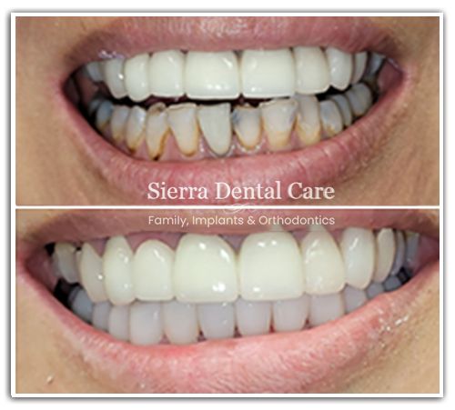 Dentist near | Invisalign Santa Clarita CA