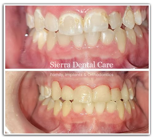 Cosmetic Dentistry Santa Clarita CA | Teeth whitening