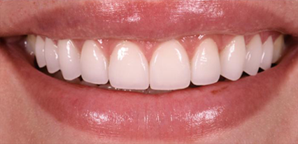 beautiful veneers smile transformation