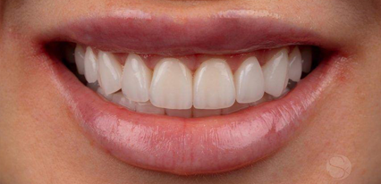 bright white smile after cosmetic dentistry