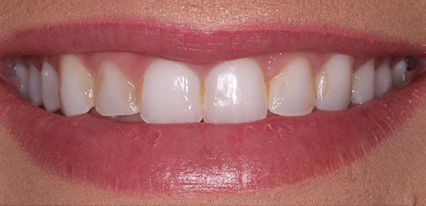 chipped teeth before cosmetic dentistry