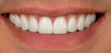 complete smile makeover results