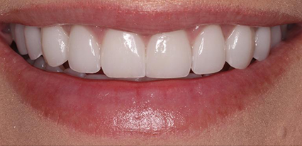 cosmetic smile makeover results