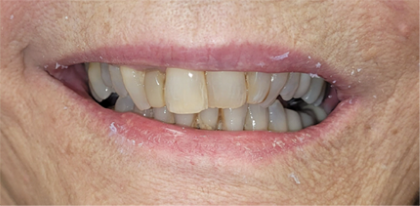 crooked teeth before cosmetic dentistry