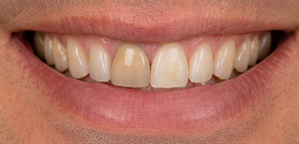 damaged teeth before smile transformation