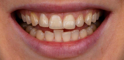 discolored teeth before smile enhancement