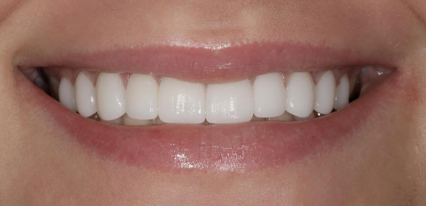 enhanced smile transformation results