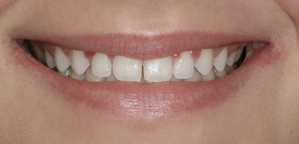 imperfect smile before cosmetic treatment