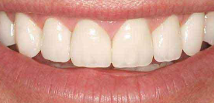 natural looking veneers after treatment results