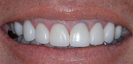 perfect smile after cosmetic treatment