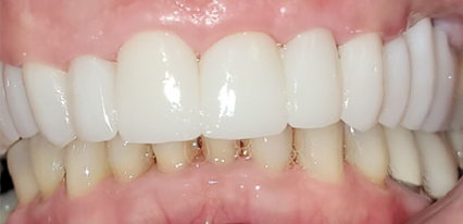 porcelain veneers smile transformation