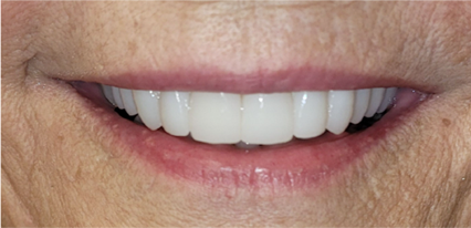 smile makeover results after treatment