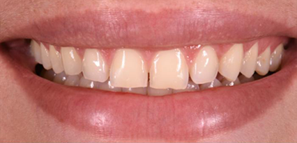 stained teeth before veneers treatment