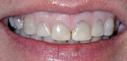 uneven smile before dental veneers