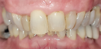 uneven teeth before porcelain veneers