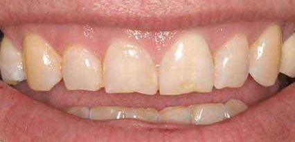worn teeth before cosmetic smile makeover