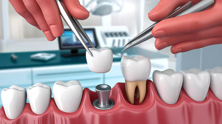 missing tooth replacement